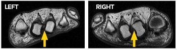 Validating Orthotic Interventions with F-Scan | Tekscan